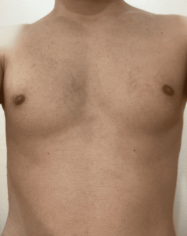 除毛後の胸毛と腹毛1